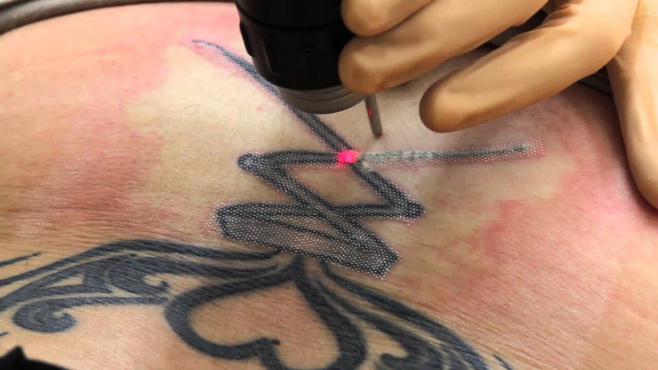 détatouage au laser